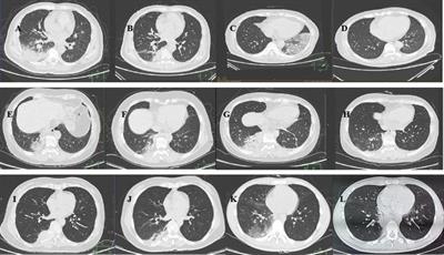 Early and rapid diagnosis of Chlamydia psittaci pneumonia by tNGS in six patients: a case series